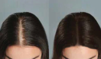 Ultraluxe RX Scalp Treatment