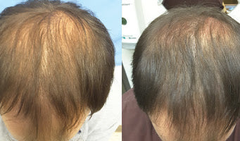 Ultraluxe RX Scalp Treatment